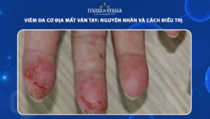 viêm da cơ địa ở ngón tay