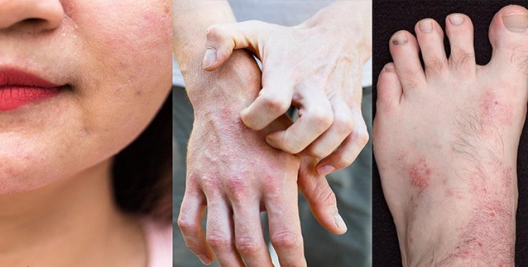 viêm da cơ địa ở người cao tuổi - Image 5