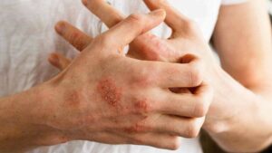 viêm da cơ địa ở người lớn