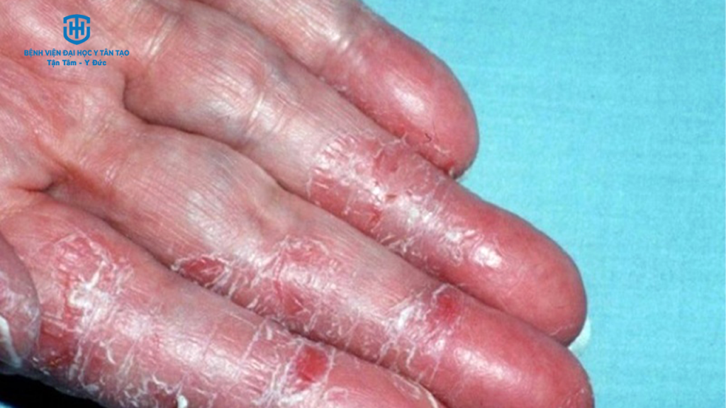 viêm da cơ địa ở người lớn - Image 4