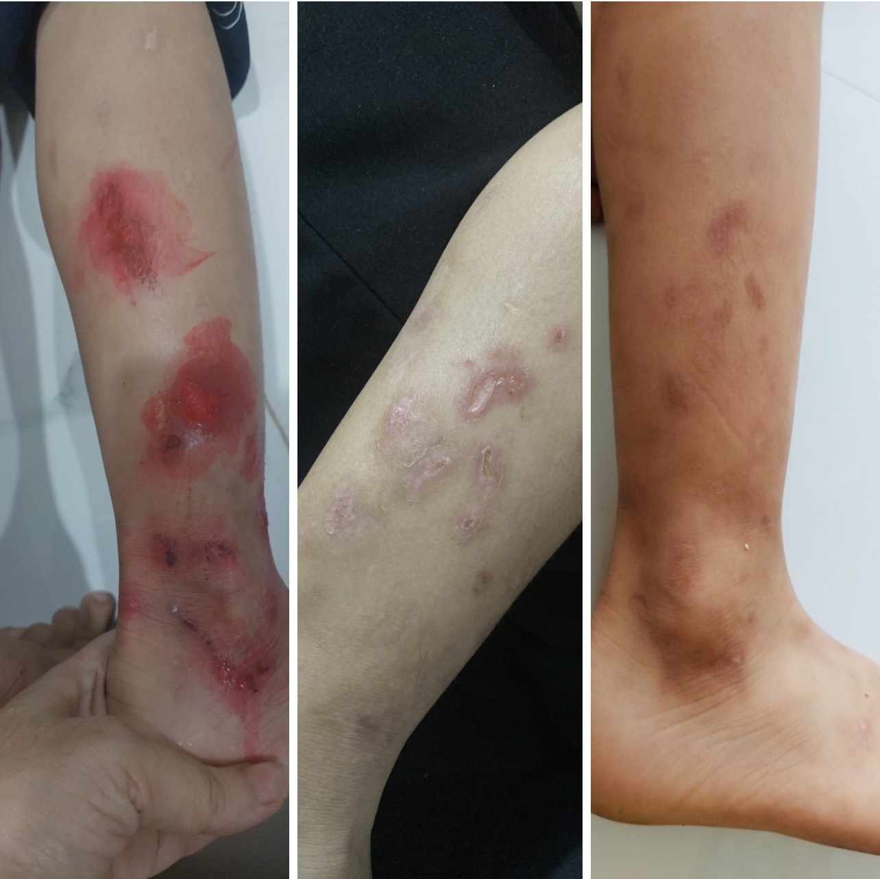 viêm da cơ địa ở trẻ em - Image 1