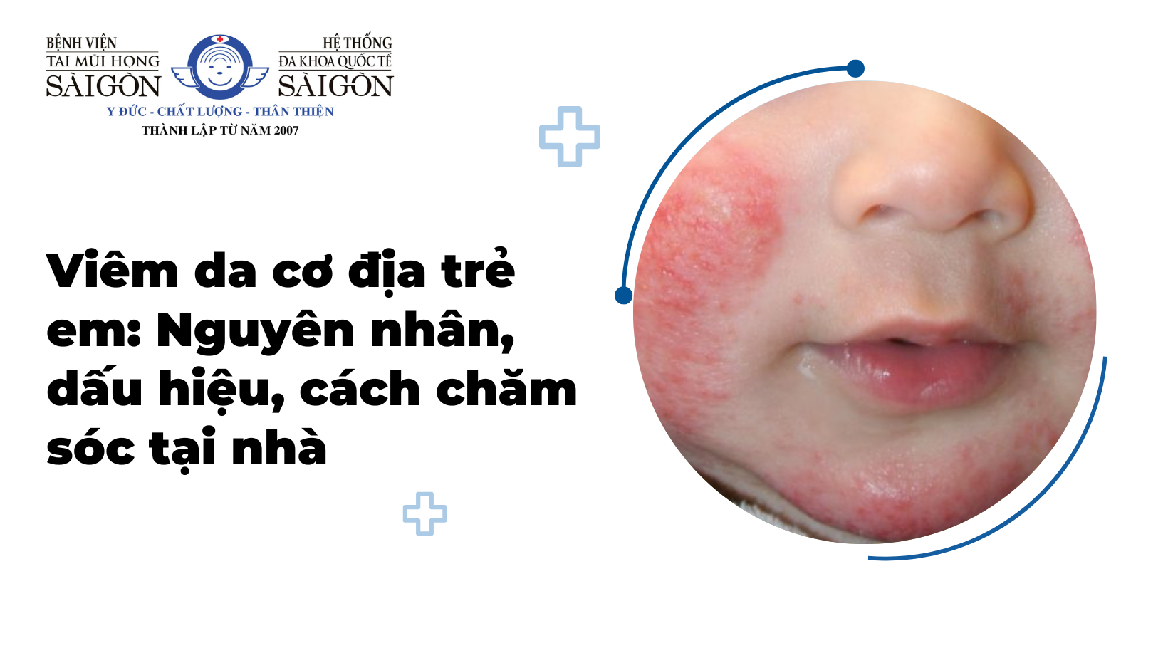 viêm da cơ địa trẻ em - Image 3