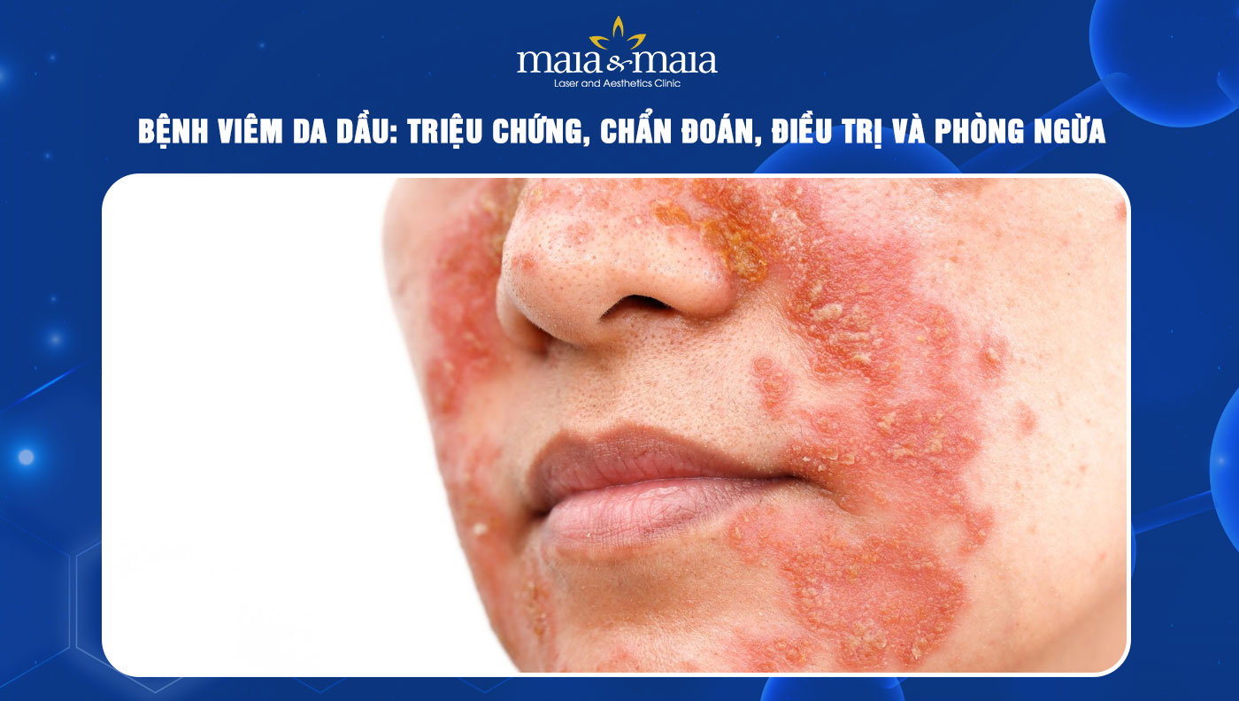 viêm da dầu - Image 2