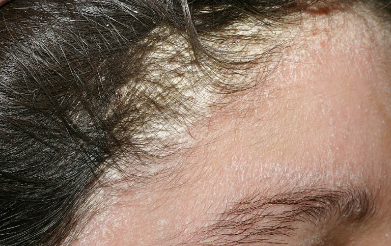 viêm da dầu ở da đầu - Image 3