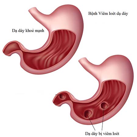 viêm dạ dày - Image 3