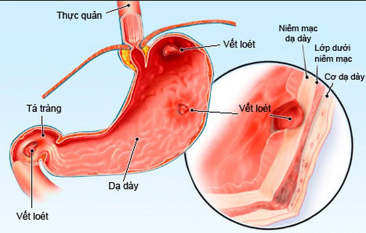 viêm dạ dày do thuốc