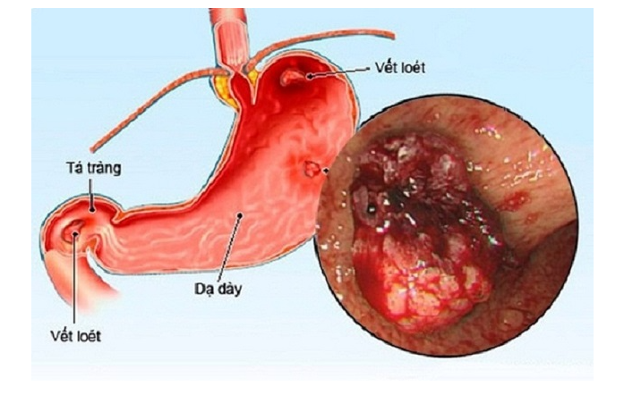 viêm dạ dày ở người cao tuổi - Image 4