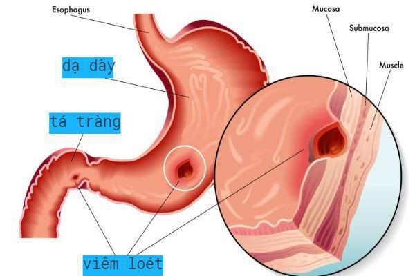 viêm dạ dày tái phát
