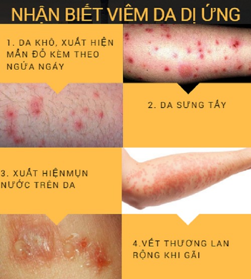 viêm da dị ứng - Image 4