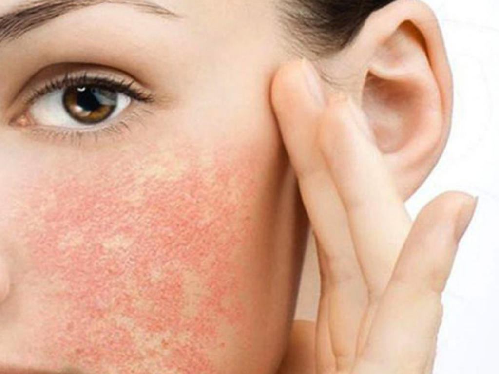 viêm da dị ứng do mỹ phẩm