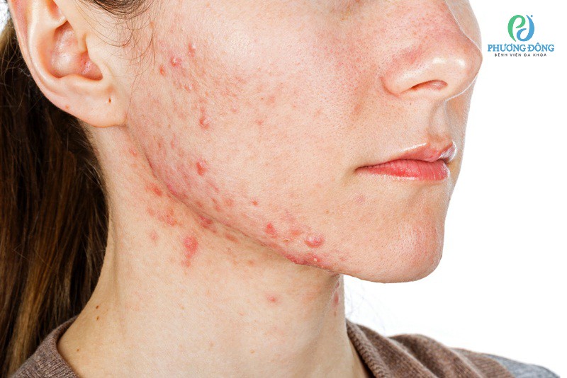 viêm da dị ứng do mỹ phẩm - Image 4