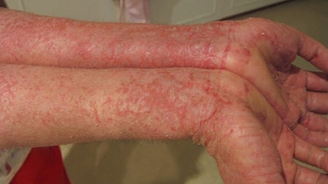 viêm da dị ứng ở người lớn - Image 2