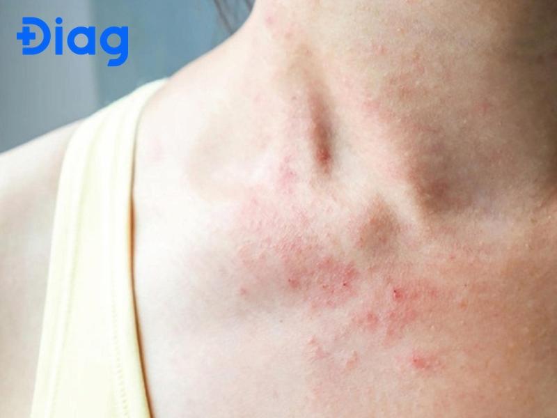 viêm da dị ứng ở người lớn - Image 5