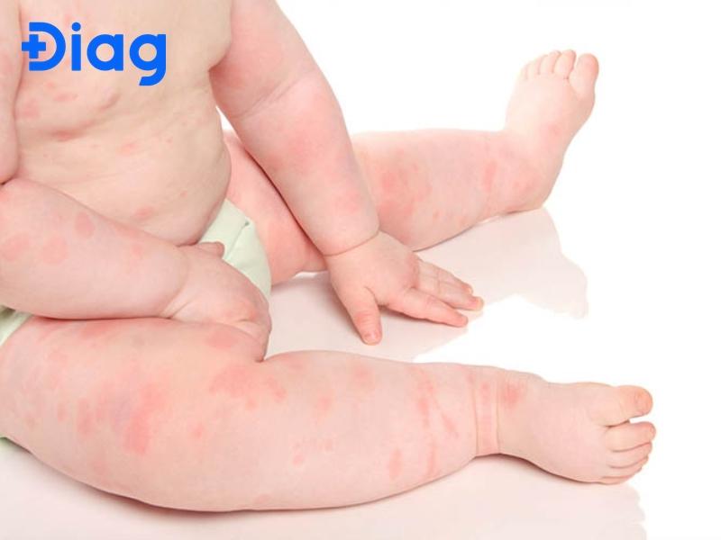 viêm da dị ứng ở trẻ