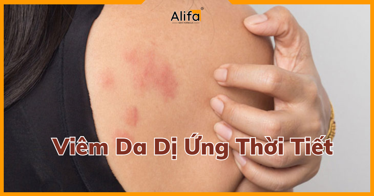 viêm da dị ứng thời tiết - Image 3