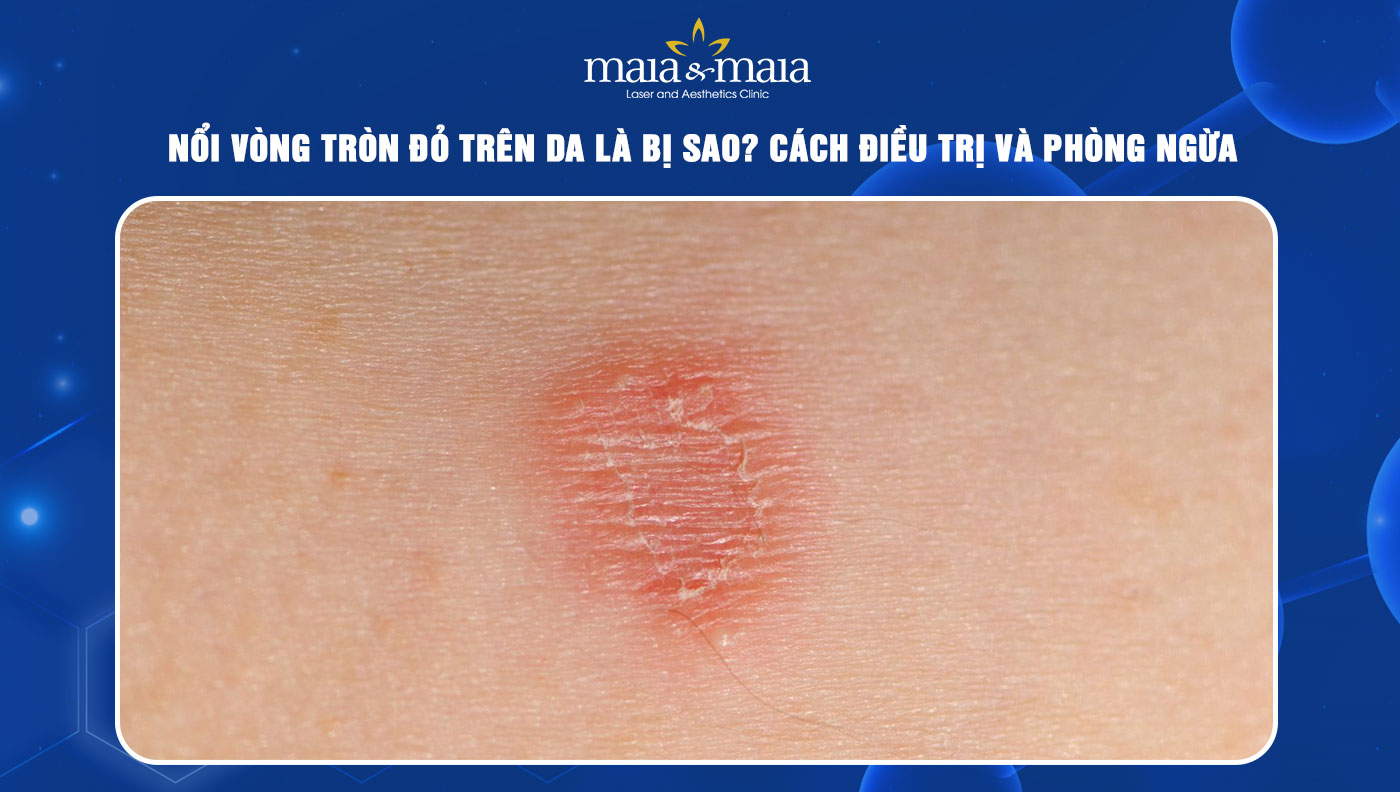 viêm da hình tròn - Image 2