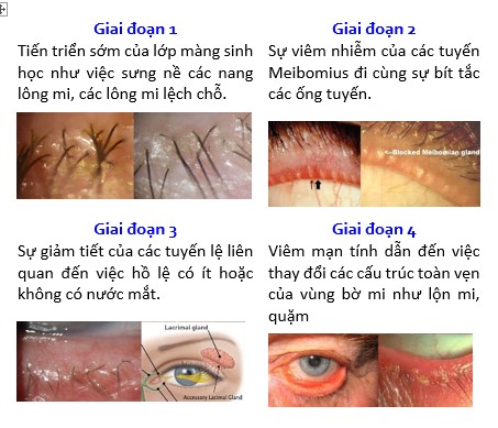 viêm da mi mắt - Image 4