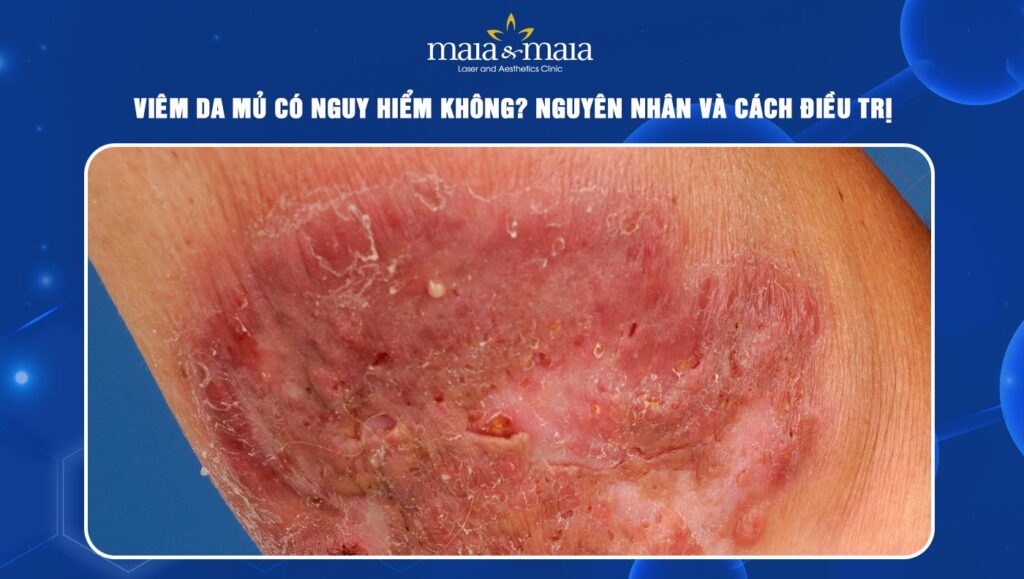 viêm da mủ