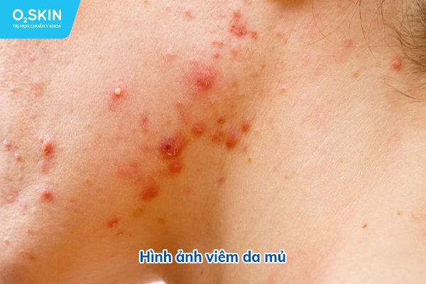viêm da mủ - Image 4