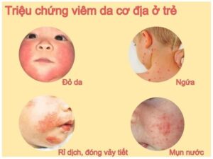 viêm da ở trẻ em