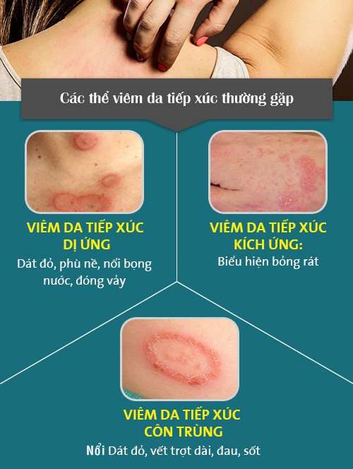 viêm da tiếp xúc - Image 2