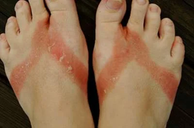 viêm da tiếp xúc dị ứng - Image 4