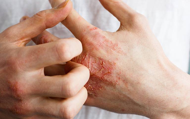 viêm da tiếp xúc do hóa chất - Image 4