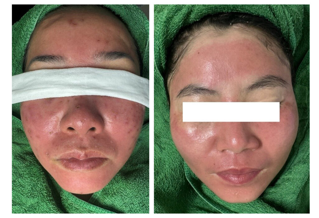 viêm da tiếp xúc do mỹ phẩm