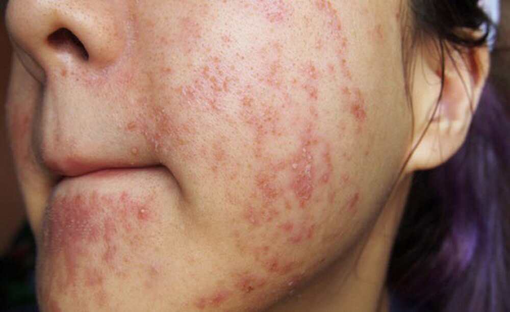 viêm da tiếp xúc do mỹ phẩm - Image 2
