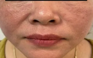 viêm da tiếp xúc do mỹ phẩm trang điểm - Image 3