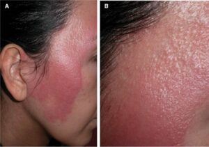 viêm da tiếp xúc do mỹ phẩm trang điểm