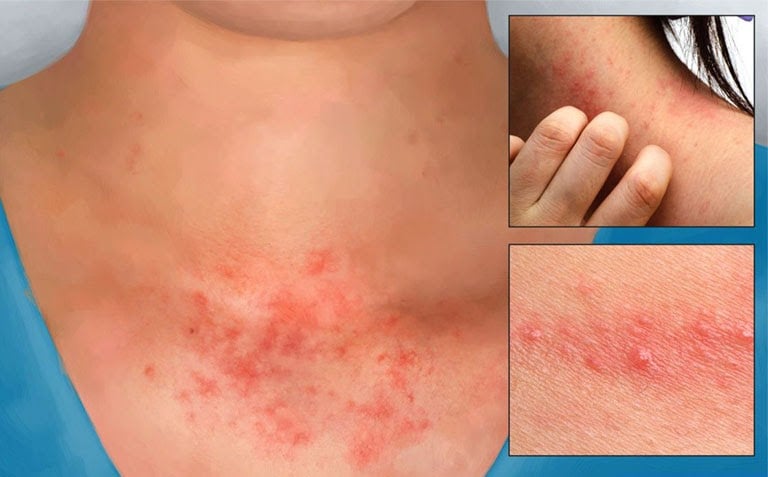 viêm da tiếp xúc do mỹ phẩm trang điểm - Image 4