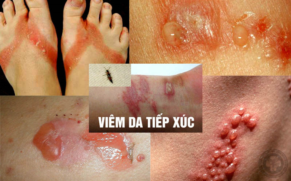 viêm da tiếp xúc do nước hoa - Image 3