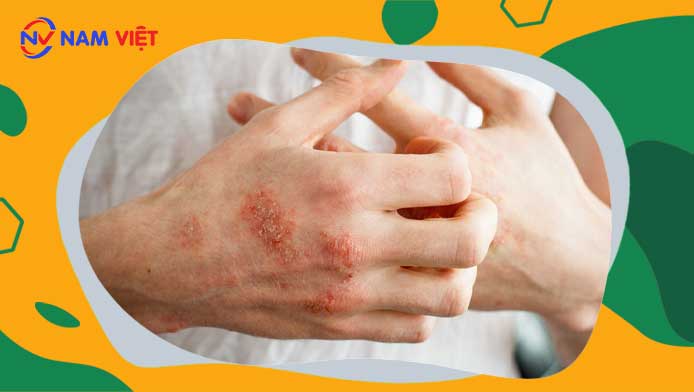 viêm da tiếp xúc nghề nghiệp