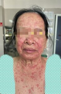 viêm da tiếp xúc ở mặt