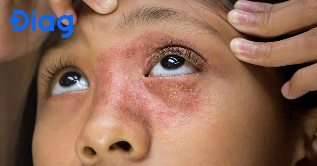 viêm da tiếp xúc ở mặt - Image 3