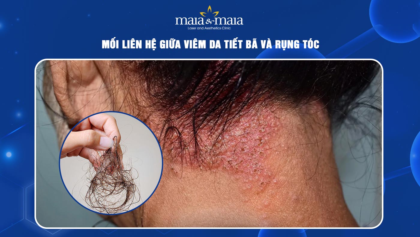 viêm da tiết bã da đầu - Image 3