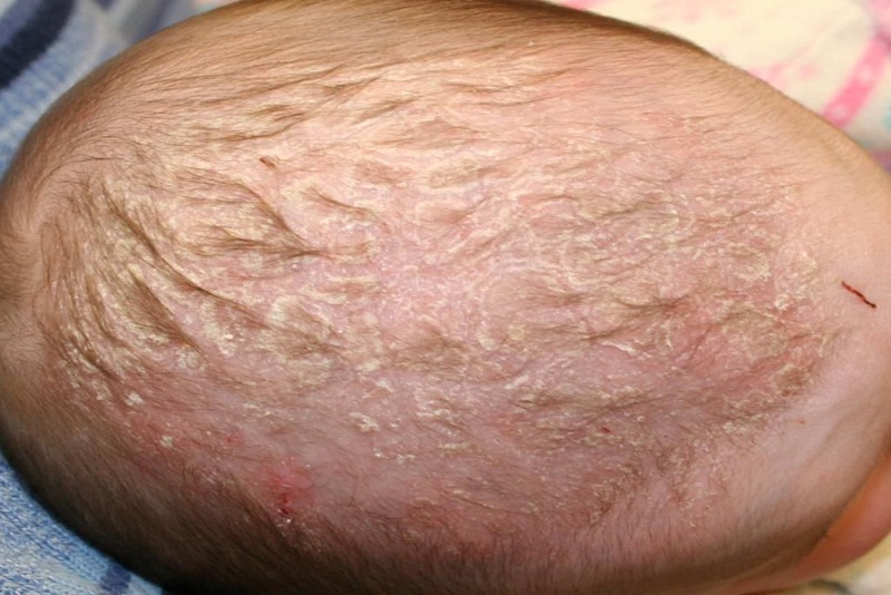 viêm da tiết bã ở trẻ sơ sinh - Image 2