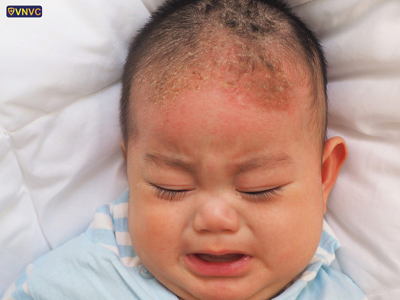 viêm da tiết bã ở trẻ sơ sinh - Image 4