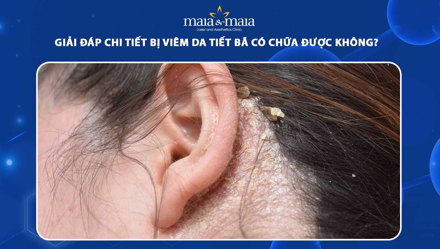 viêm da tiết bã quanh tai - Image 3