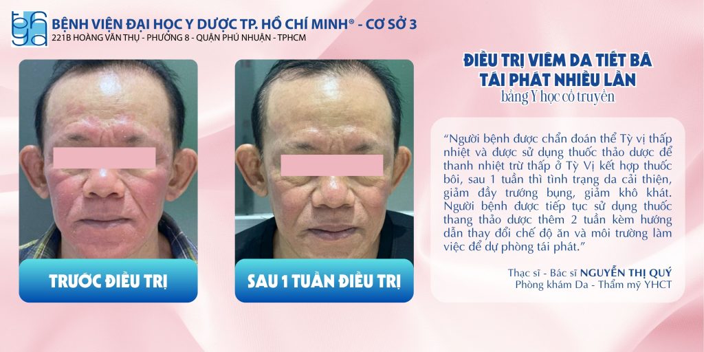 viêm da tiết bã tái phát - Image 2