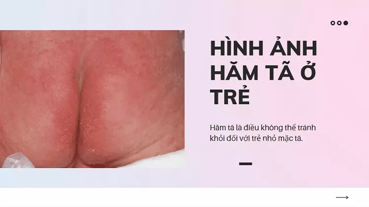 viêm da vùng tã ở trẻ sơ sinh - Image 4