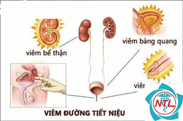 viêm đường tiết niệu - Image 4