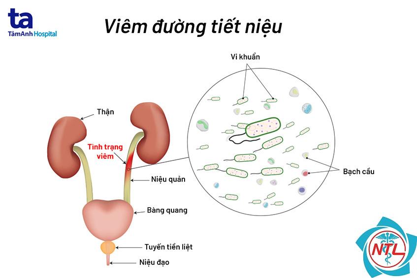 viêm đường tiểu - Image 2