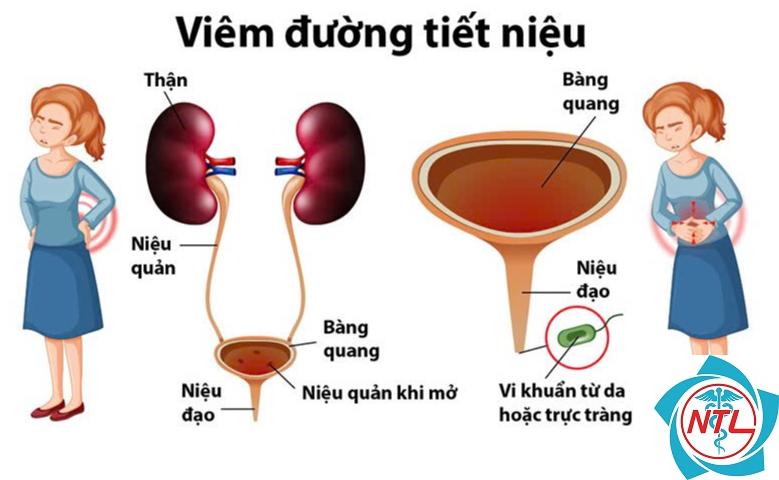 viêm đường tiểu