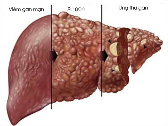 viêm gan - Image 2