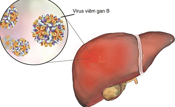 viêm gan B - Image 4