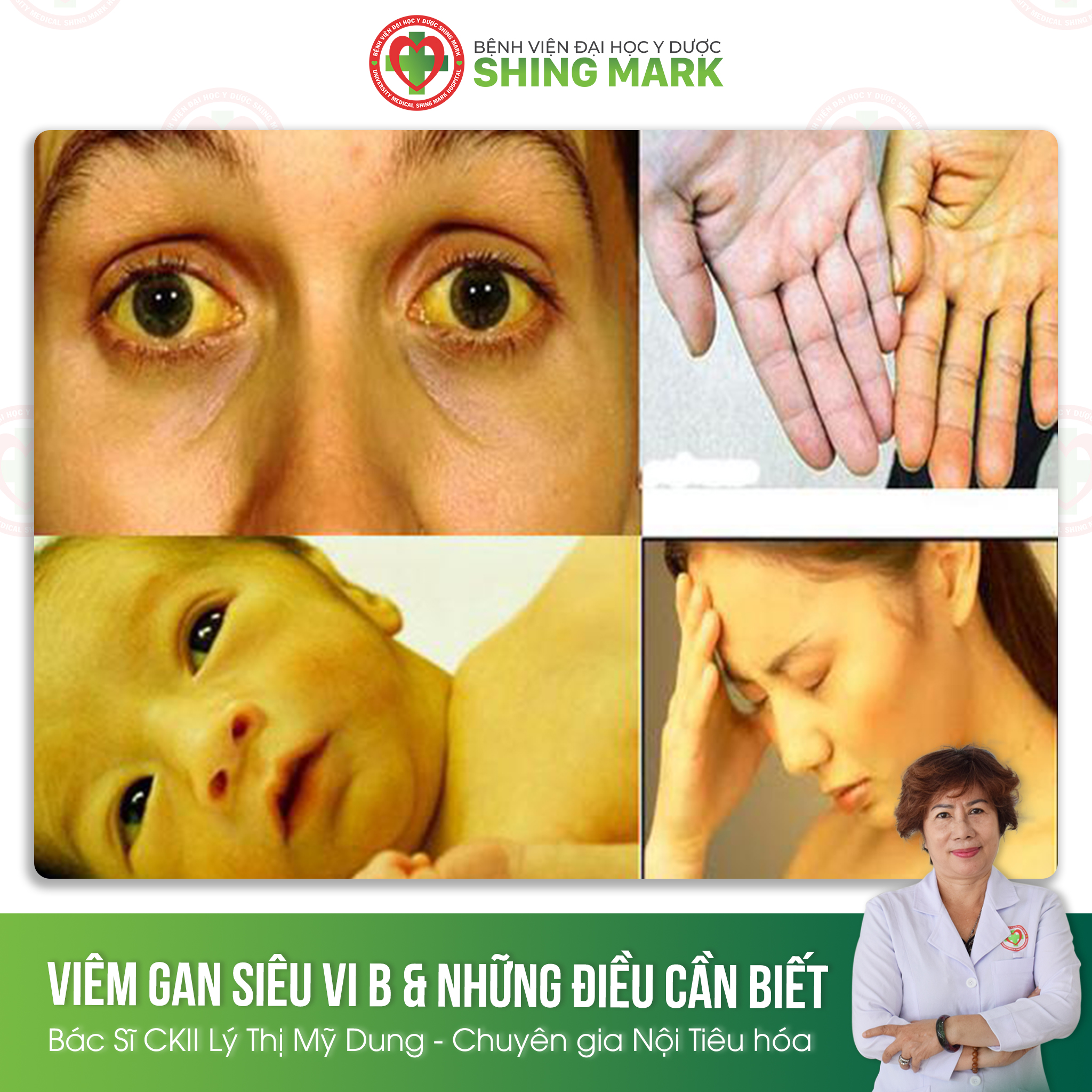 viêm gan B - Image 5