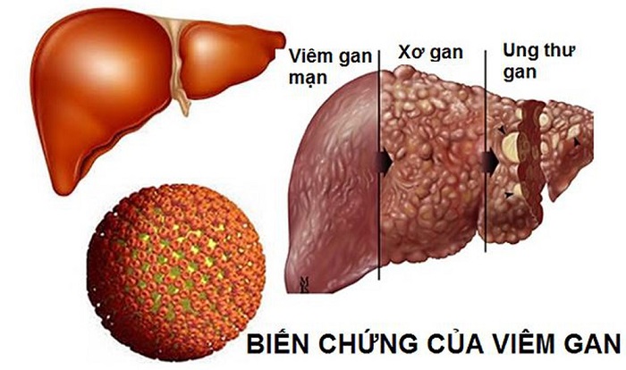 viêm gan B mạn tính - Image 2