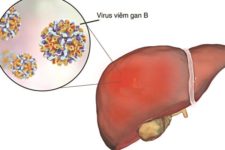 viêm gan B ở người lớn - Image 3